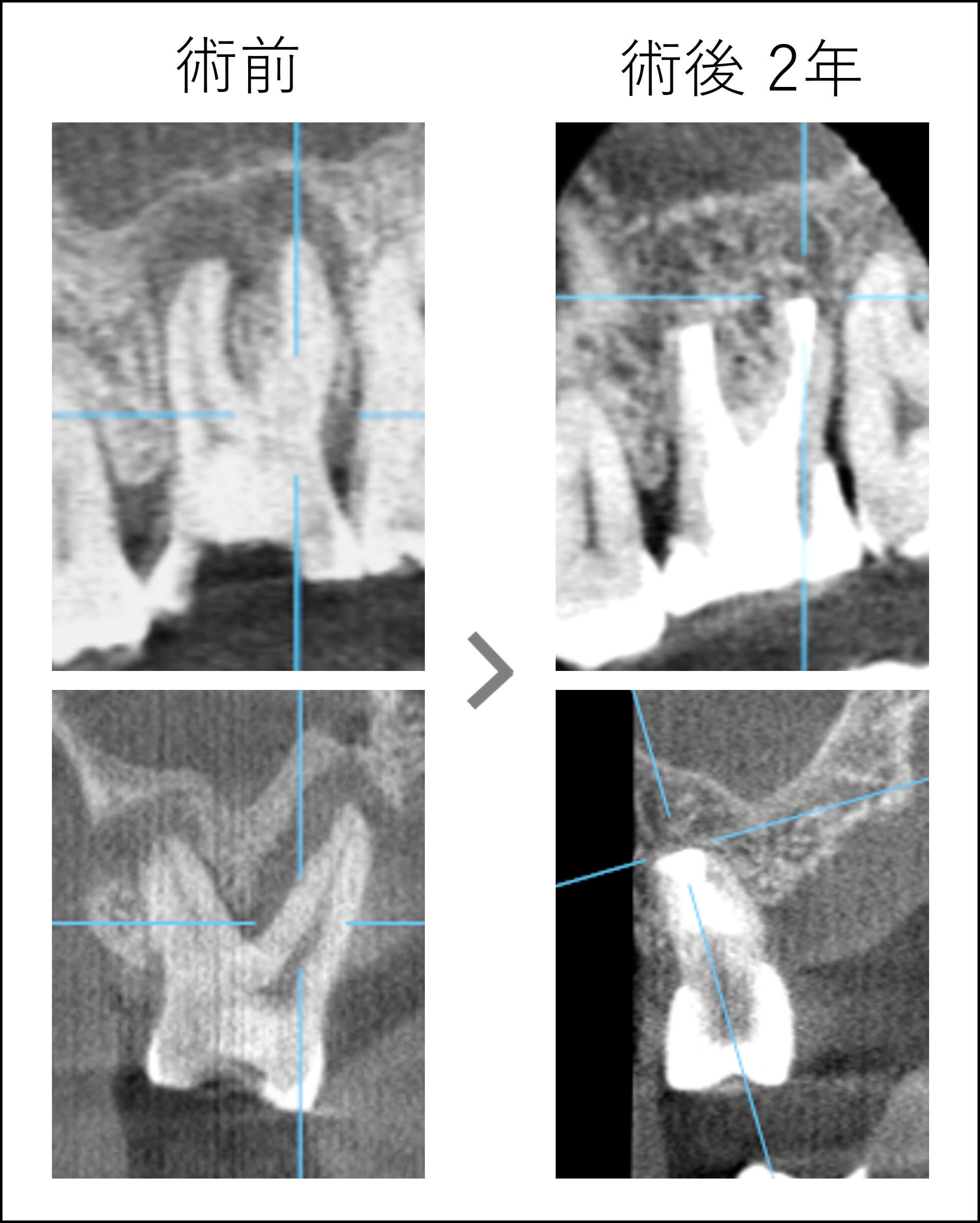 術後2年で治癒している