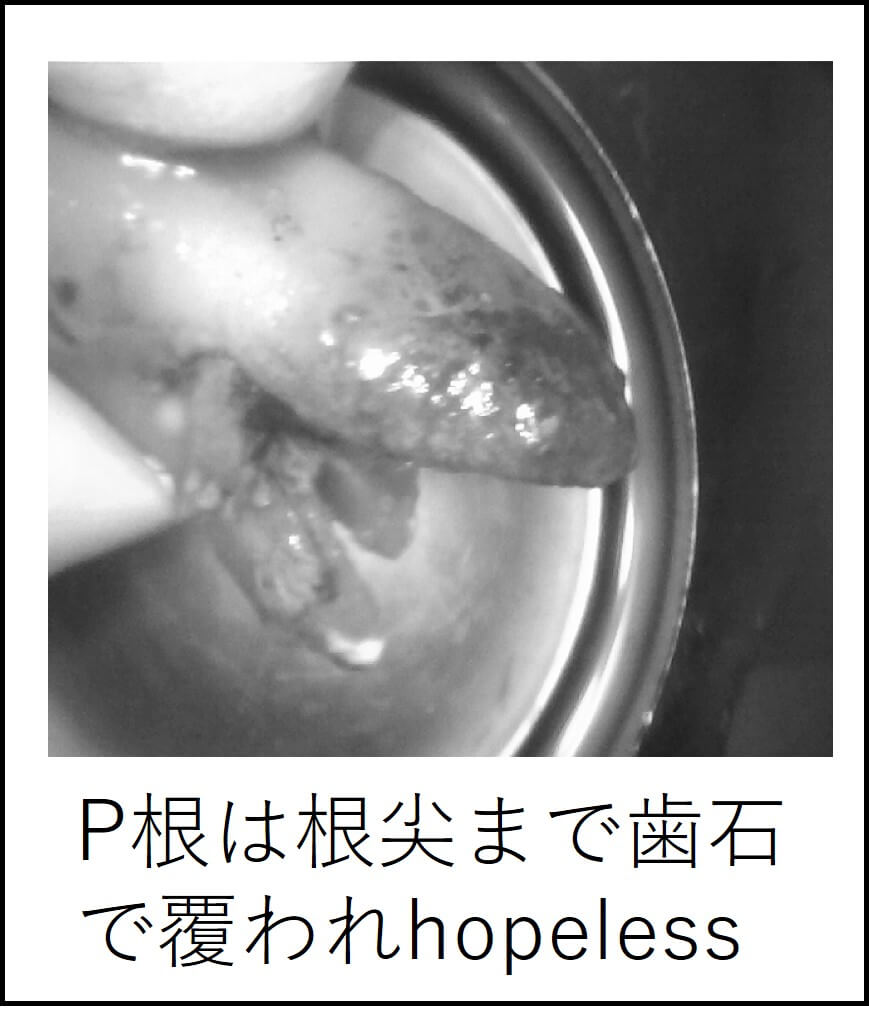 P根は根尖まで歯石で覆われていた