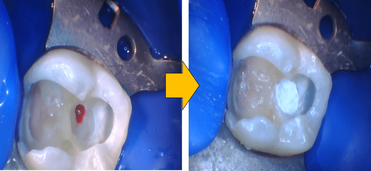 治療前後のみの比較写真：虫歯が深く露髄した神経をMTAセメントで覆髄