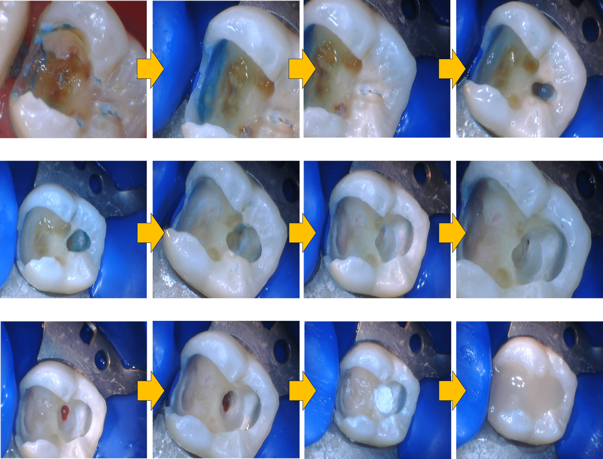 治療の流れの写真：虫歯の除去から露髄、MTA直接覆髄、バルクベース封鎖まで
