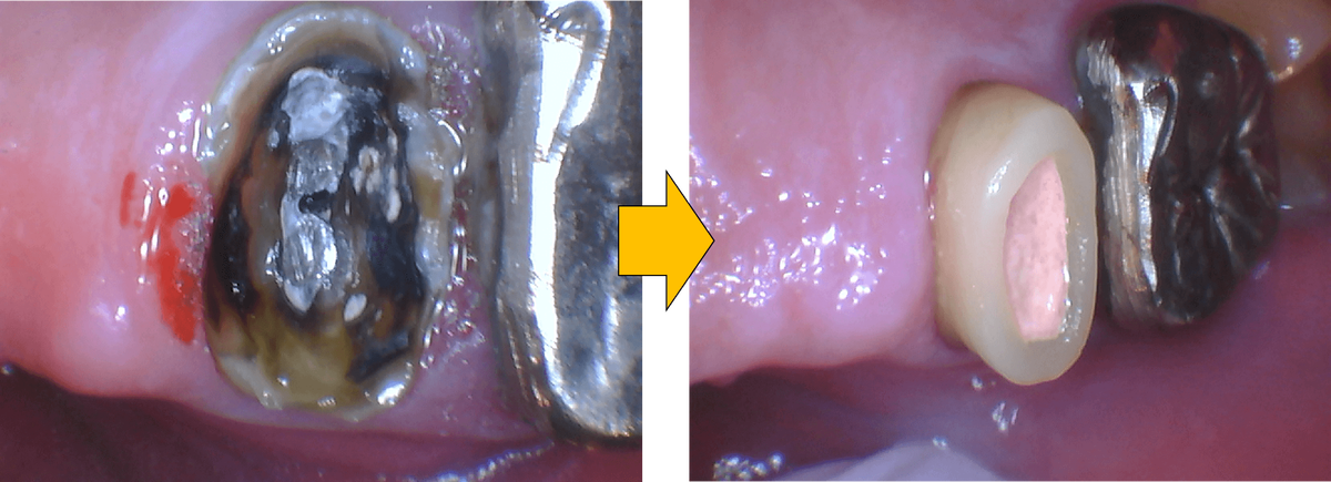 治療前後のみの比較写真：虫歯が深くラバーがかけられない状態からかけられる状態へ