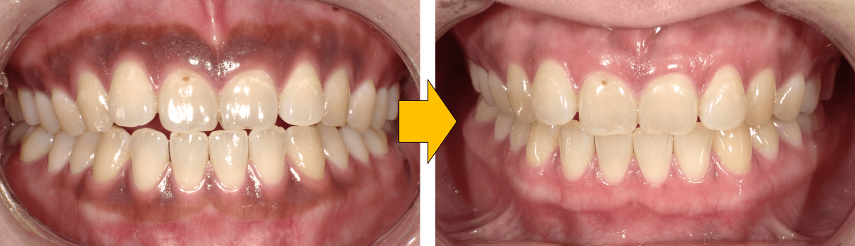 治療前後の比較写真：歯茎のメラニン色素を除去した比較写真