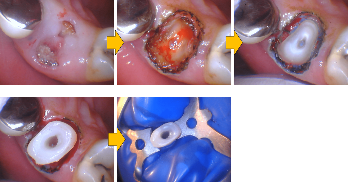 治療の流れの写真：歯肉のGP処置から隔壁処置まで