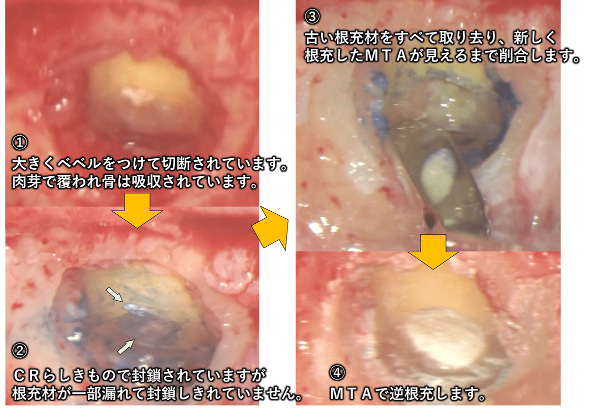 治療の流れの写真：マイクロスコープ下で歯根端切除リカバリー