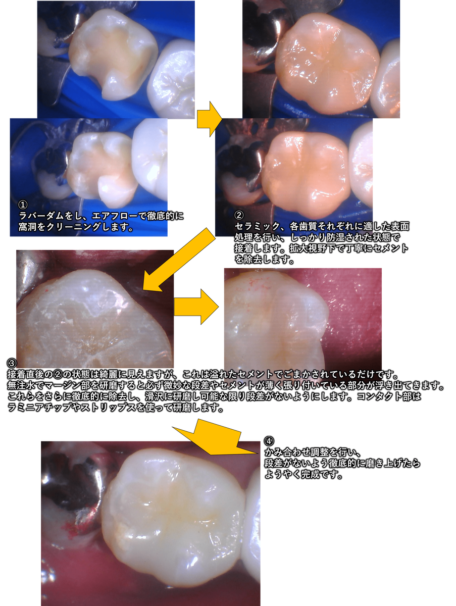 治療の流れの写真：ラバーダムをマージン下までしっかり入れ込み可能な限り最大限に乾燥させた状態でのセラミックの接着操作
