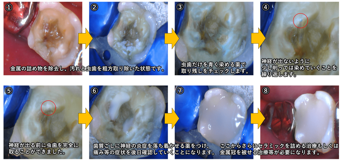 虫歯除去～間接覆髄までの流れ
