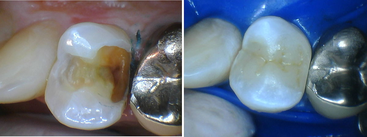 小臼歯のダイレクトボンディング例
