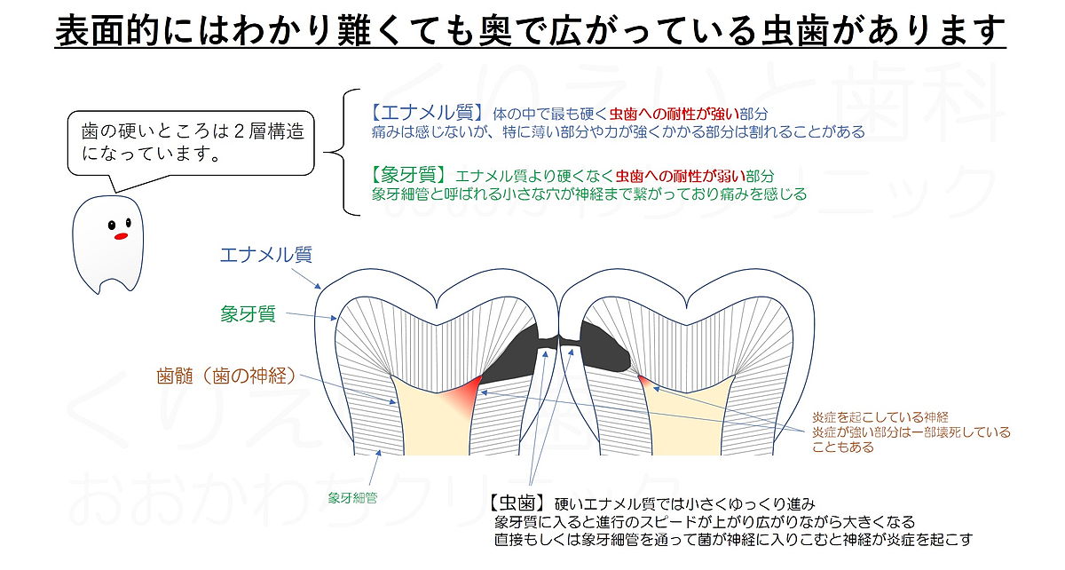 虫歯の説明