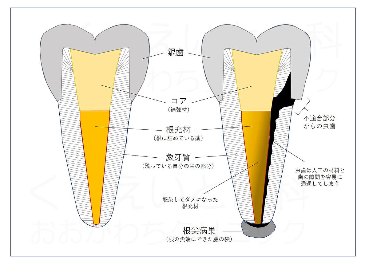 左の図：感染していない神経のない歯　右の図：虫歯に感染して病巣ができた歯